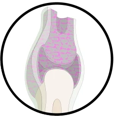 Bio-ceramics for bone prosthetics